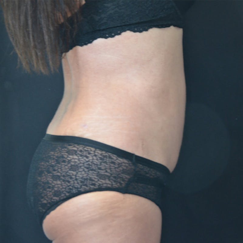 Liposuction Before & After Gallery - Patient 114721121 - Image 6