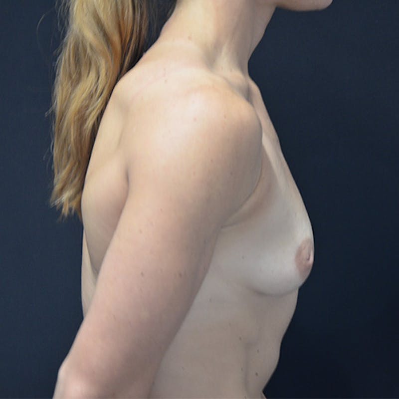 Breast Augmentation Before & After Gallery - Patient 114721117 - Image 7