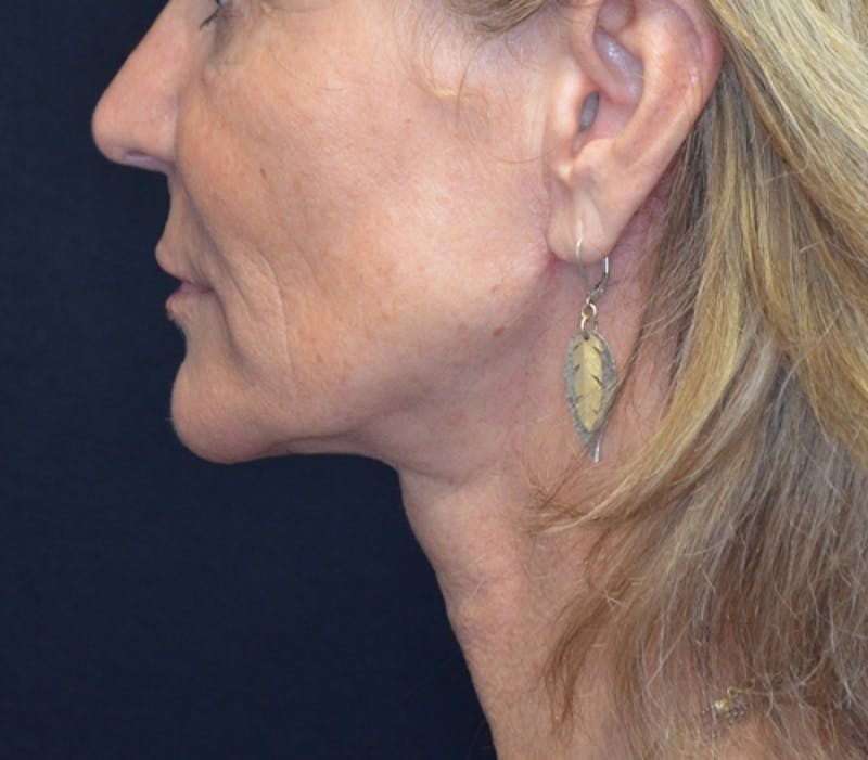 Neck Lift Before & After Gallery - Patient 114721120 - Image 1