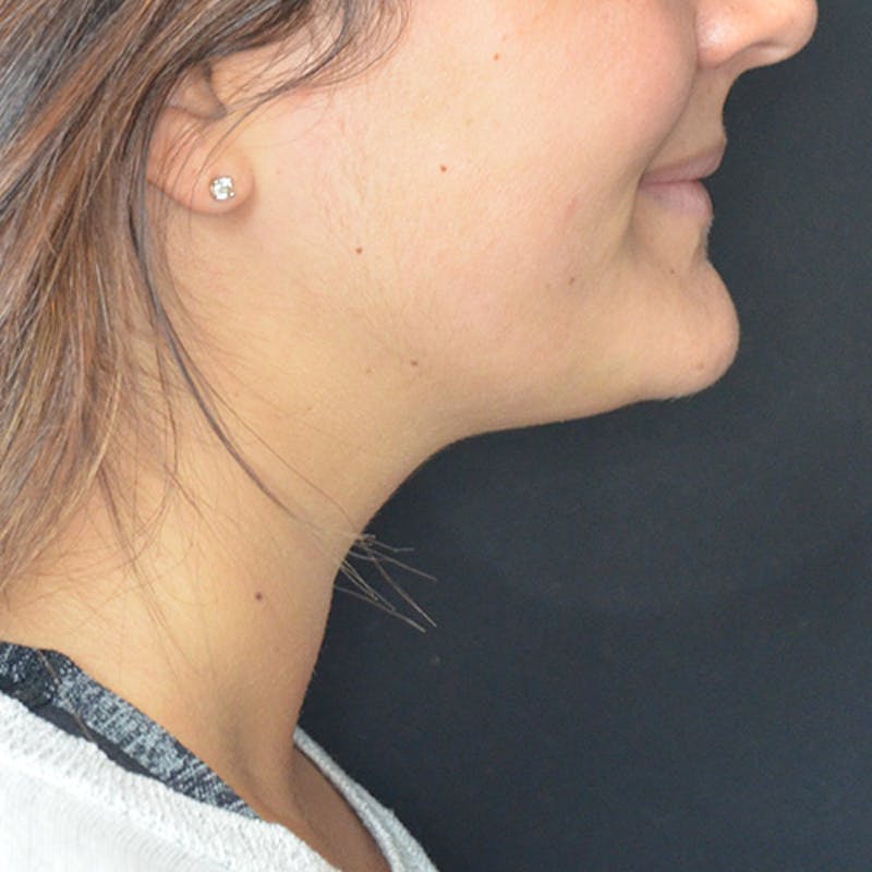 Dermal Fillers Before & After Gallery - Patient 114721114 - Image 2