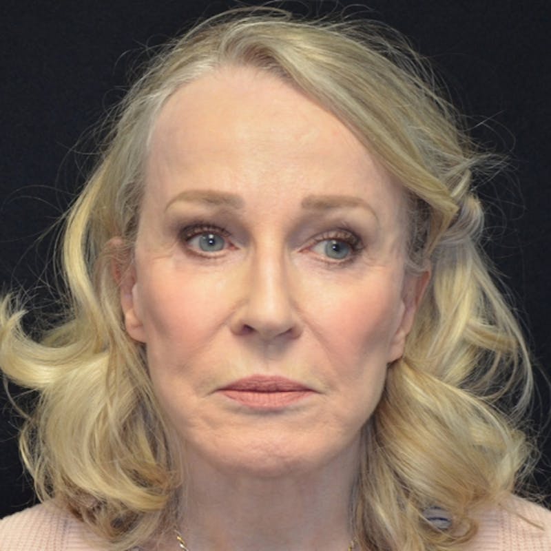 Facelift Before & After Gallery - Patient 114721126 - Image 2