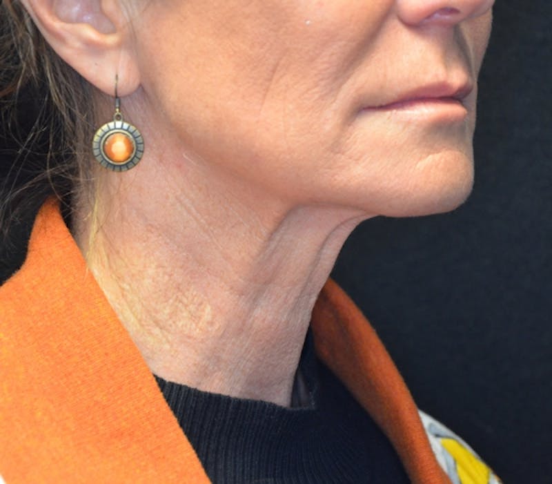 Neck Lift Before & After Gallery - Patient 114721120 - Image 8
