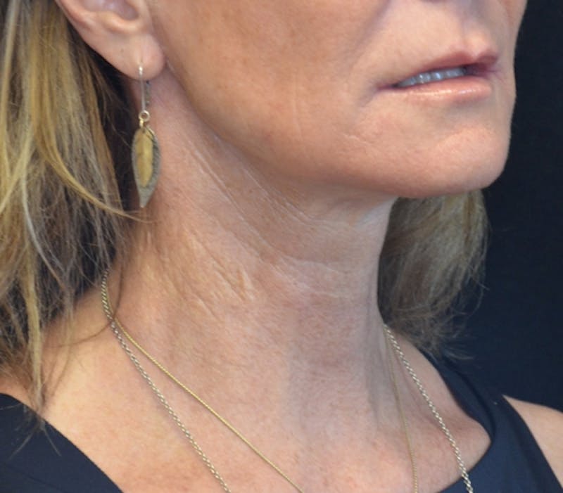 Neck Lift Before & After Gallery - Patient 114721120 - Image 7