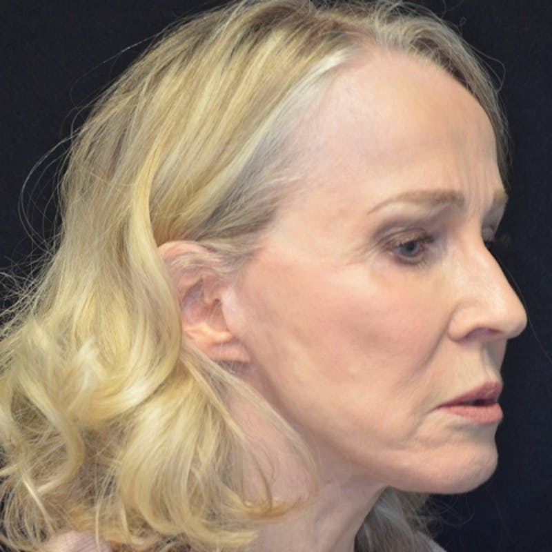 Facelift Before & After Gallery - Patient 114721126 - Image 4