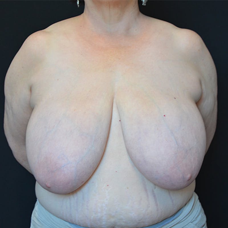 Breast Reduction Before & After Gallery - Patient 114721127 - Image 1