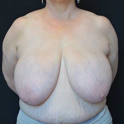 Breast Reduction Before & After Gallery - Patient 114721127 - Image 1