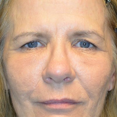 Brow Lift Before & After Gallery - Patient 114721119 - Image 1