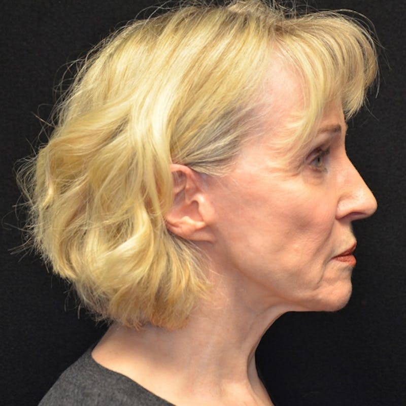 Facelift Before & After Gallery - Patient 114721126 - Image 5
