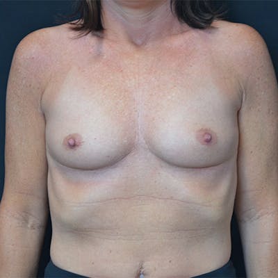 Breast Augmentation Before & After Gallery - Patient 114721129 - Image 1