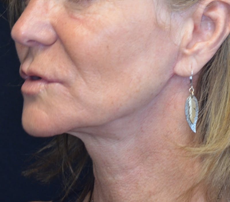 Neck Lift Before & After Gallery - Patient 114721120 - Image 3