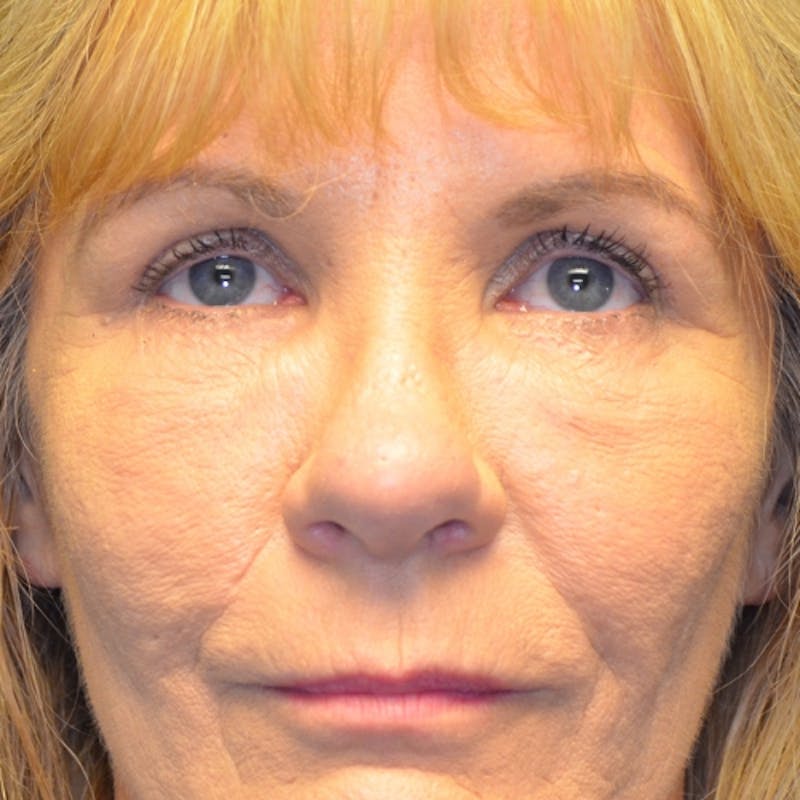 Brow Lift Before & After Gallery - Patient 114721119 - Image 2