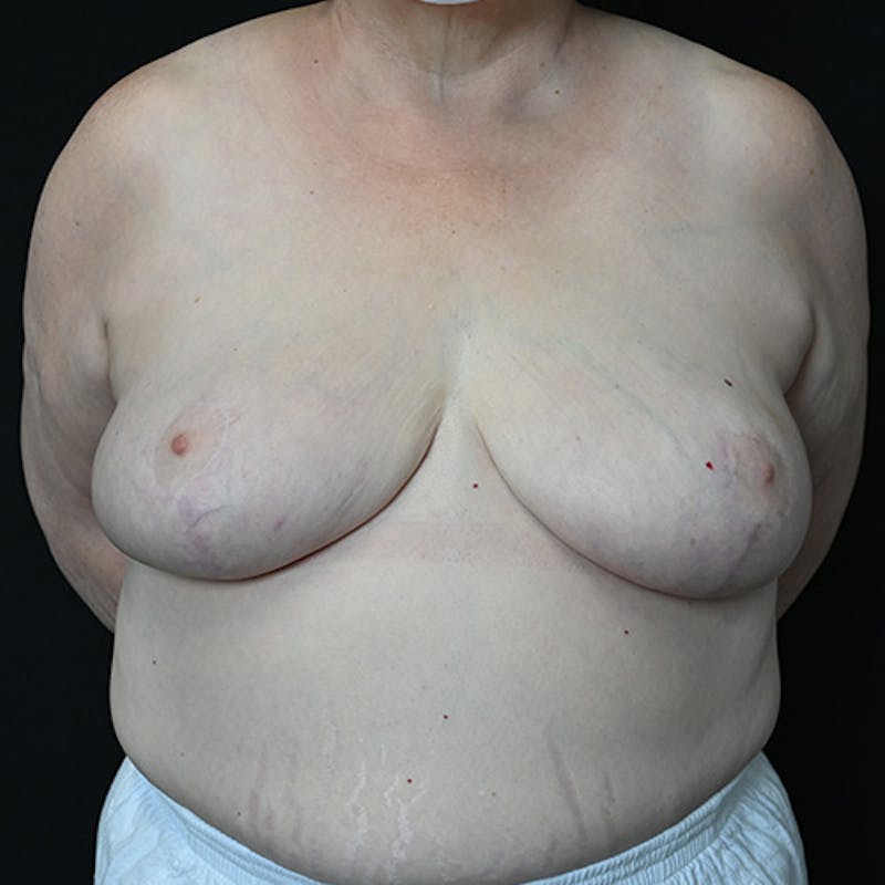 Breast Reduction Before & After Gallery - Patient 114721127 - Image 2