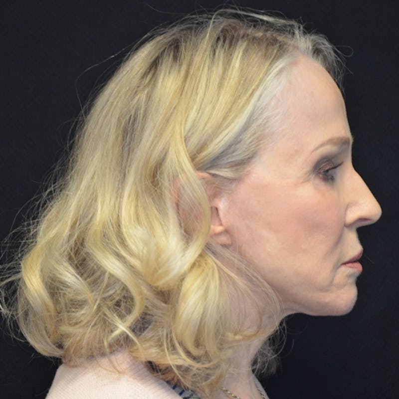 Facelift Before & After Gallery - Patient 114721126 - Image 6