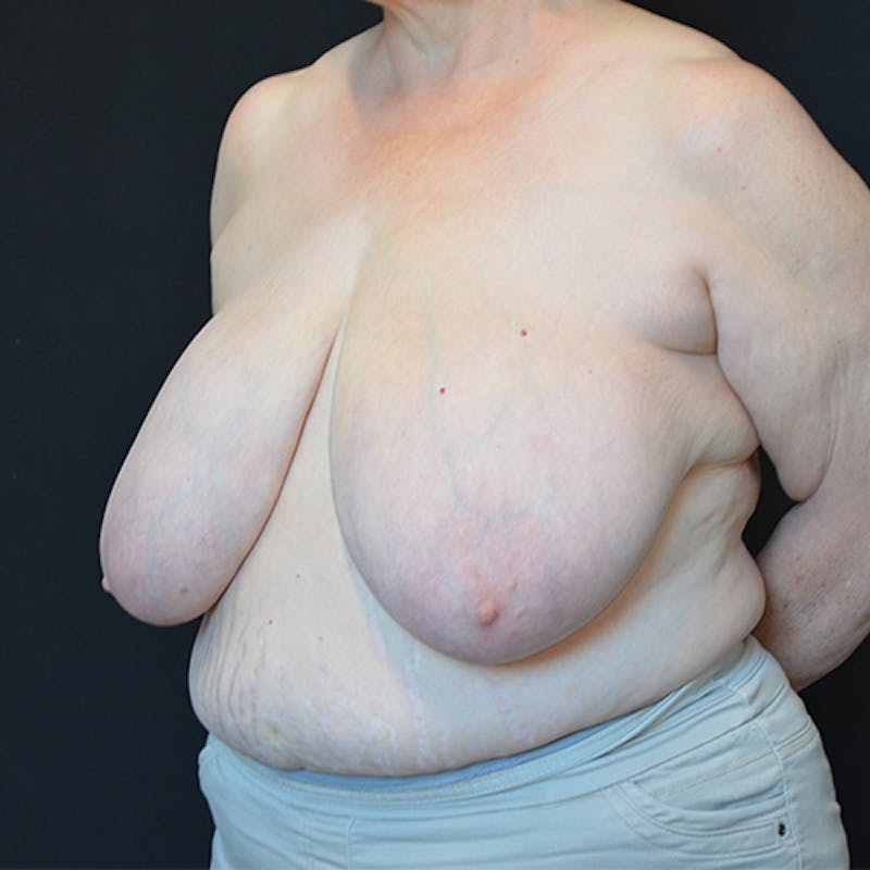 Breast Reduction Before & After Gallery - Patient 114721127 - Image 3
