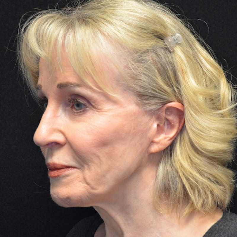 Facelift Before & After Gallery - Patient 114721126 - Image 7