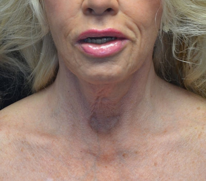 Neck Lift Before & After Gallery - Patient 114721133 - Image 5