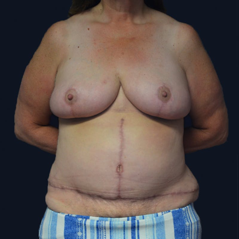 Mommy Makeover Before & After Gallery - Patient 114721132 - Image 2