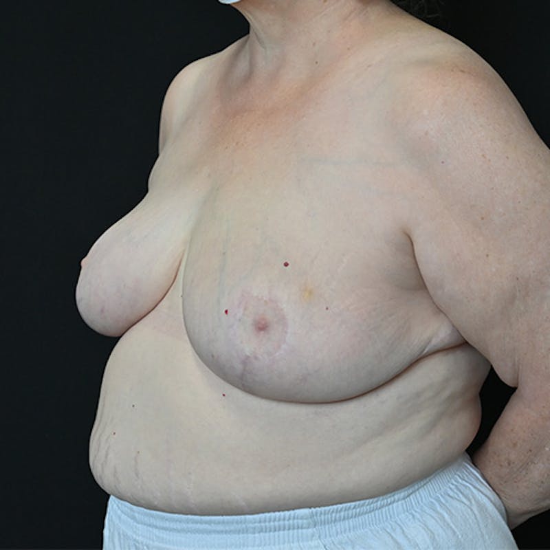 Breast Reduction Before & After Gallery - Patient 114721127 - Image 4