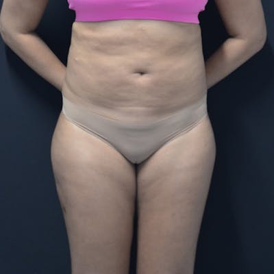 Liposuction Before & After Gallery - Patient 114721135 - Image 1