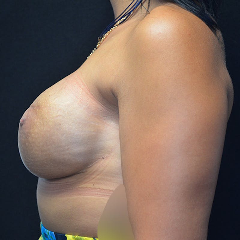 Breast Reconstruction Before & After Gallery - Patient 114721125 - Image 10