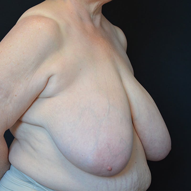 Breast Reduction Before & After Gallery - Patient 114721127 - Image 5