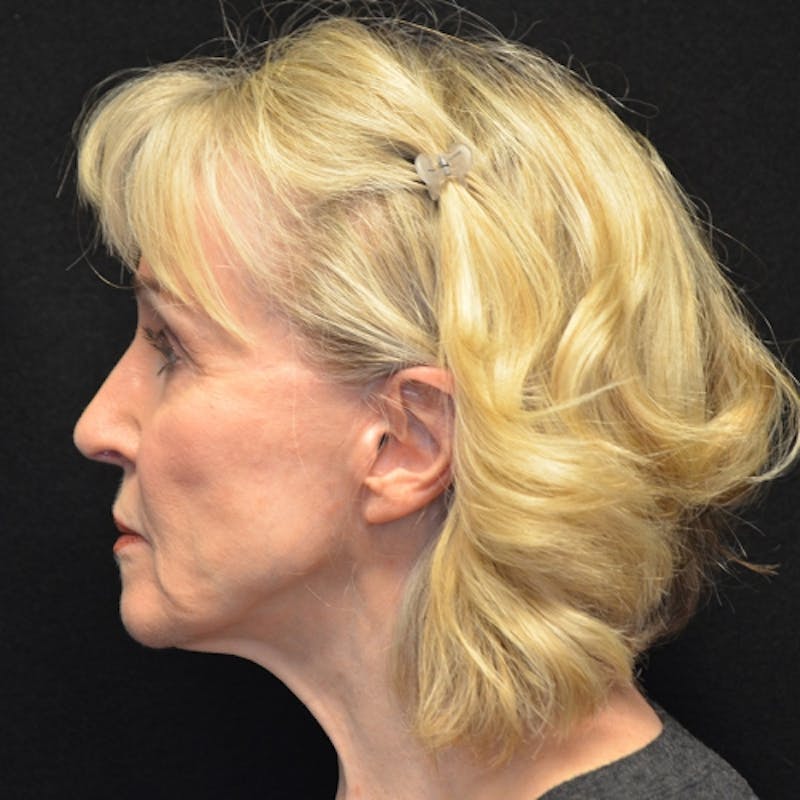 Facelift Before & After Gallery - Patient 114721126 - Image 9