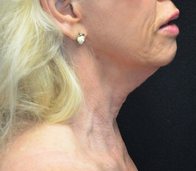 Neck Lift Before & After Gallery - Patient 114721133 - Image 9