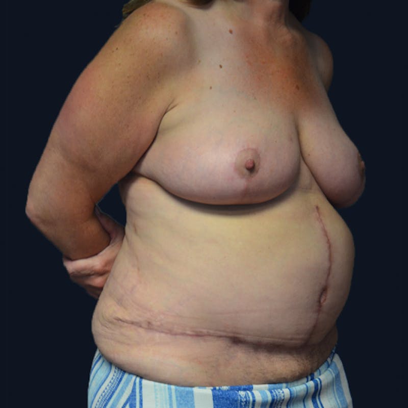 Mommy Makeover Before & After Gallery - Patient 114721132 - Image 4