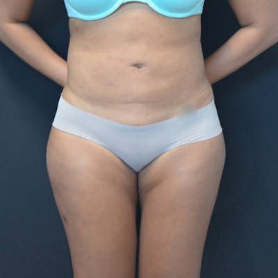 Liposuction Before & After Gallery - Patient 114721135 - Image 2