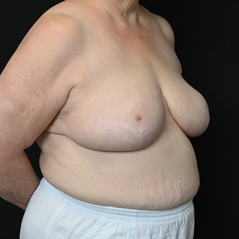 Breast Reduction Before & After Gallery - Patient 114721127 - Image 6