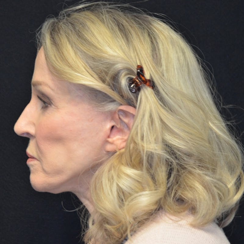Facelift Before & After Gallery - Patient 114721126 - Image 10