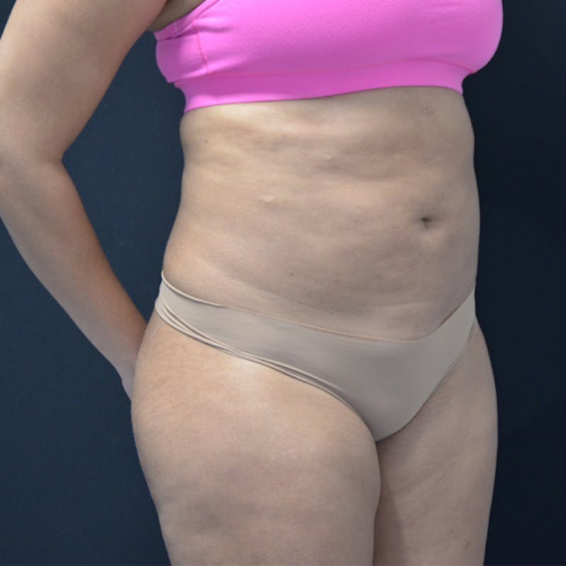 Liposuction Before & After Gallery - Patient 114721135 - Image 3