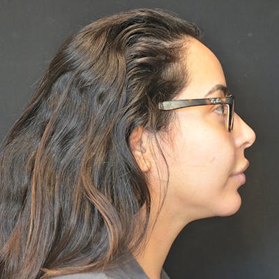 Chin Augmentation Before & After Gallery - Patient 114721128 - Image 2