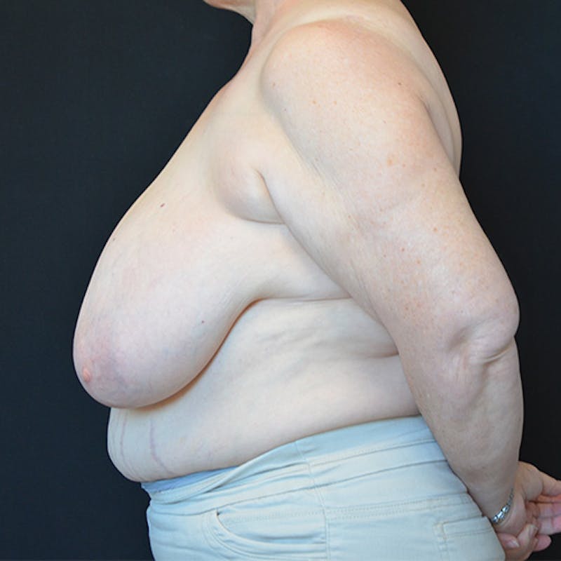 Breast Reduction Before & After Gallery - Patient 114721127 - Image 7