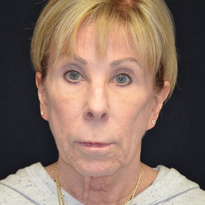 Facelift Before & After Gallery - Patient 114721137 - Image 1