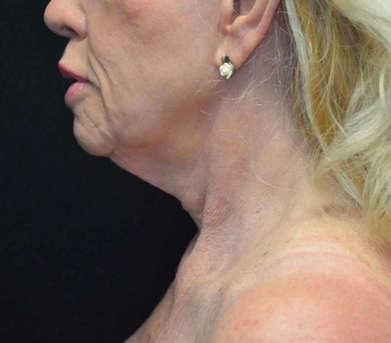 Neck Lift Before & After Gallery - Patient 114721133 - Image 1