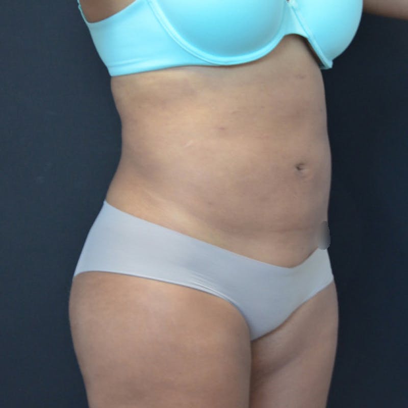 Liposuction Before & After Gallery - Patient 114721135 - Image 4