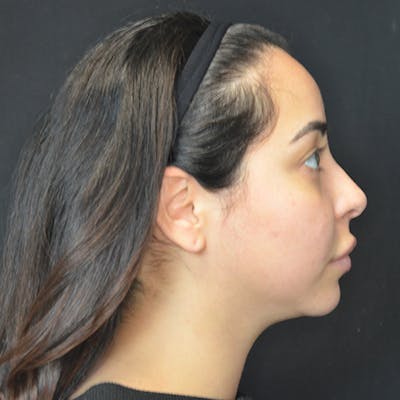 Chin Augmentation Before & After Gallery - Patient 114721128 - Image 1