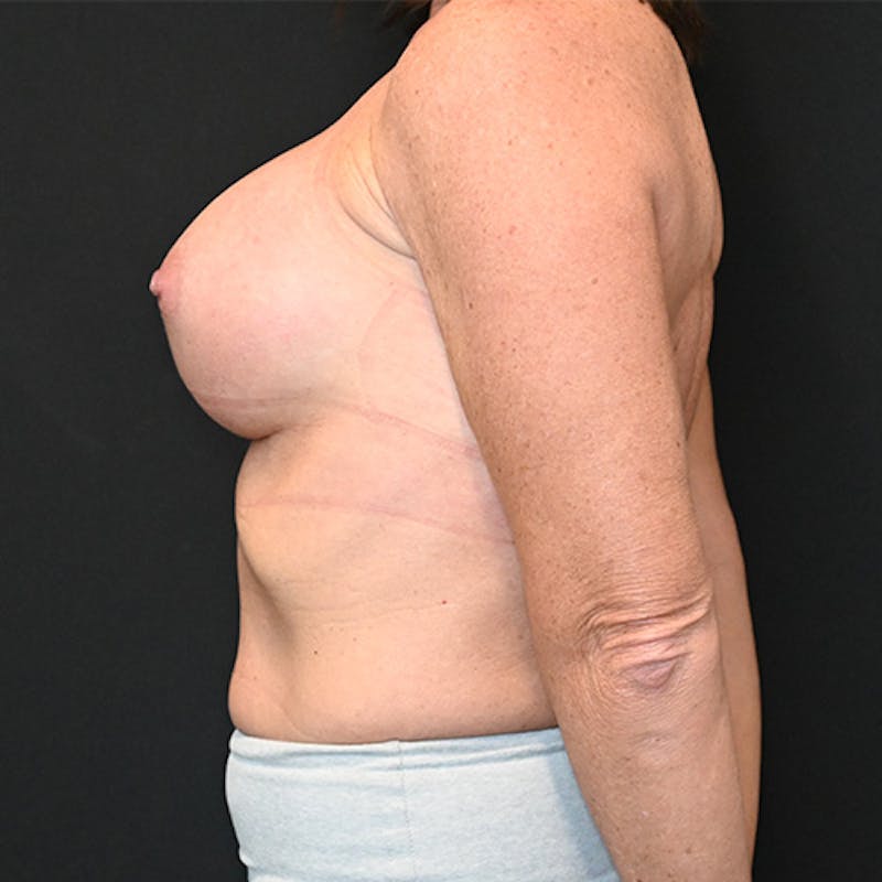 Breast Augmentation Before & After Gallery - Patient 114721129 - Image 8