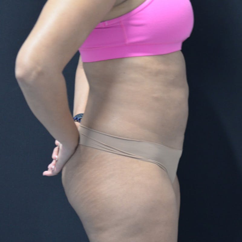 Liposuction Before & After Gallery - Patient 114721135 - Image 5