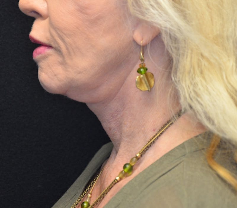 Neck Lift Before & After Gallery - Patient 114721133 - Image 2