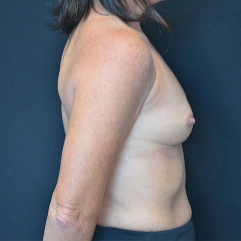 Breast Augmentation Before & After Gallery - Patient 114721129 - Image 9