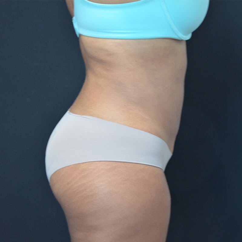 Liposuction Before & After Gallery - Patient 114721135 - Image 6
