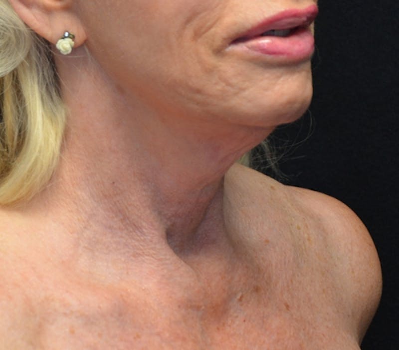 Neck Lift Before & After Gallery - Patient 114721133 - Image 7