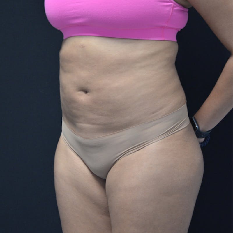 Liposuction Before & After Gallery - Patient 114721135 - Image 7