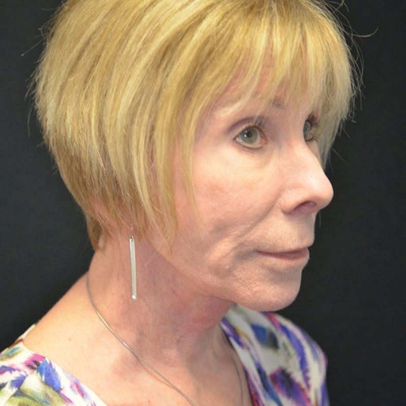 Facelift Before & After Gallery - Patient 114721137 - Image 4