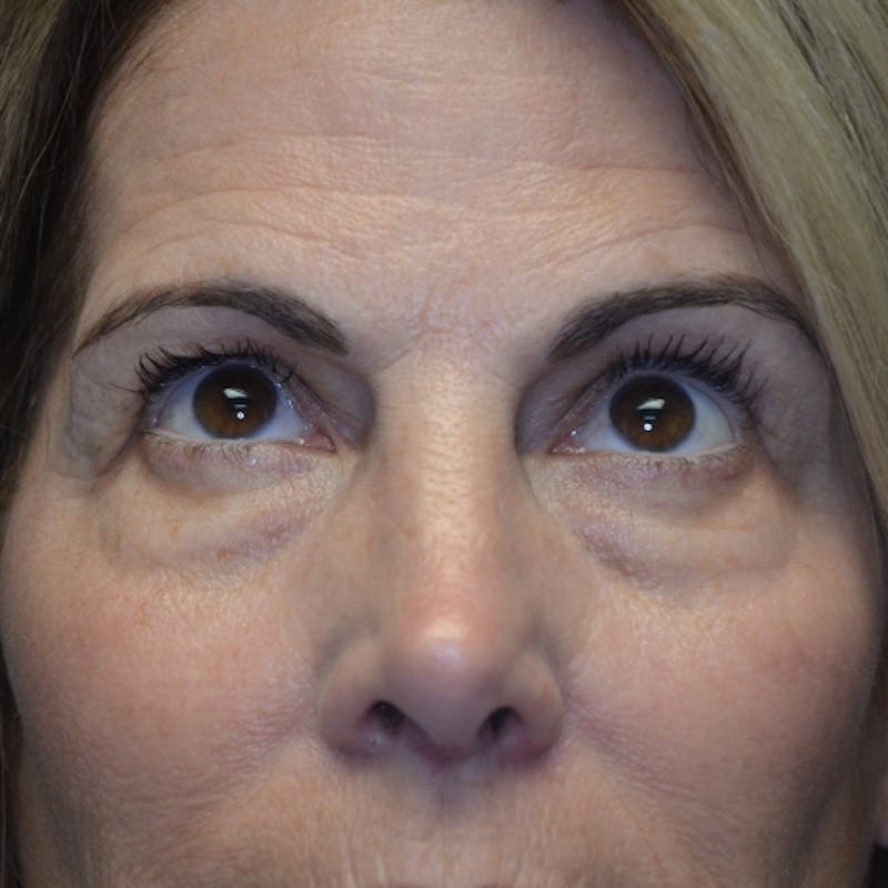 Lower Eyelid Surgery Before & After Gallery - Patient 118186860 - Image 1
