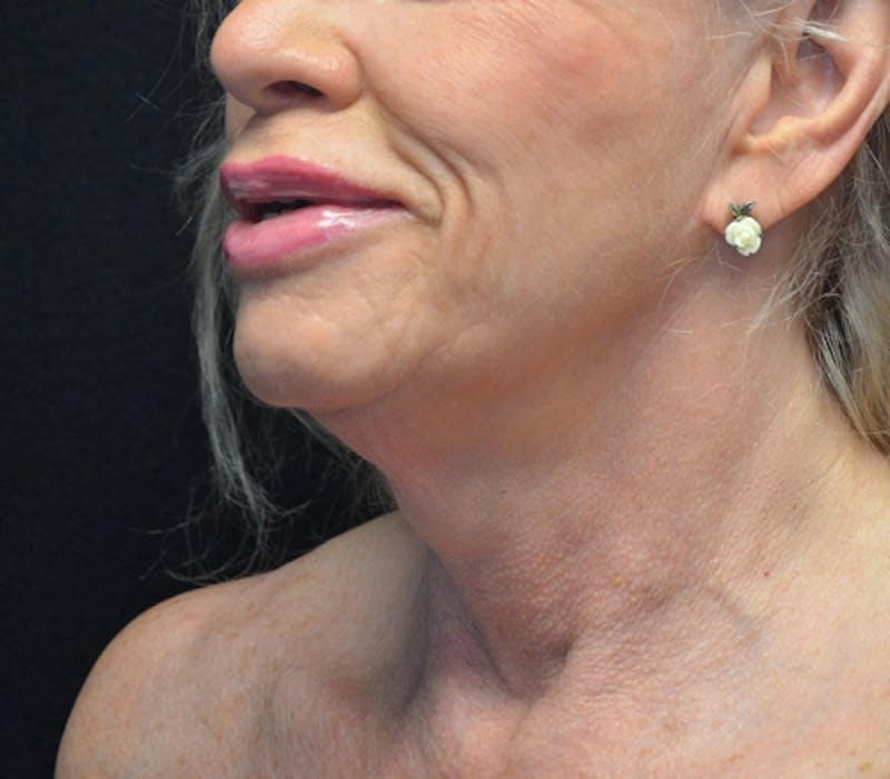Neck Lift Before & After Gallery - Patient 114721133 - Image 3