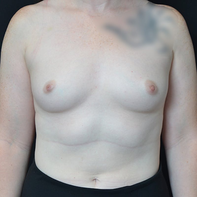 Breast Augmentation Before & After Gallery - Patient 114721134 - Image 1