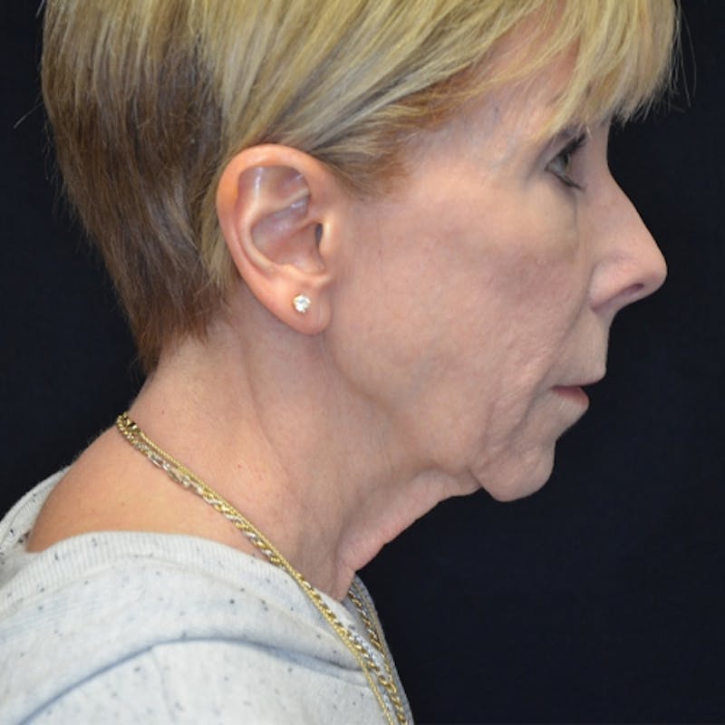 Facelift Before & After Gallery - Patient 114721137 - Image 5